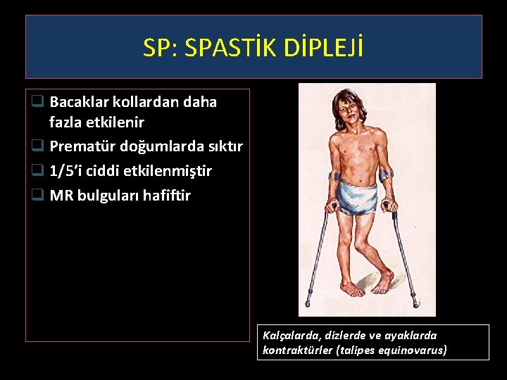 SP: SPASTİK DİPLEJİ q Bacaklar kollardan daha fazla etkilenir q Prematür doğumlarda sıktır q