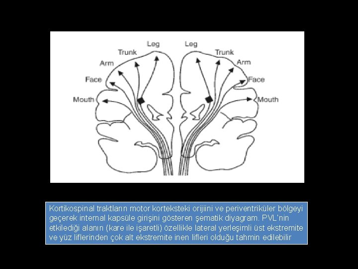 Kortikospinal traktların motor korteksteki orijiini ve periventriküler bölgeyi geçerek internal kapsüle girişini gösteren şematik