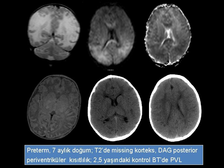 Preterm, 7 aylık doğum; T 2’de missing korteks, DAG posterior periventriküler kısıtlılık; 2, 5