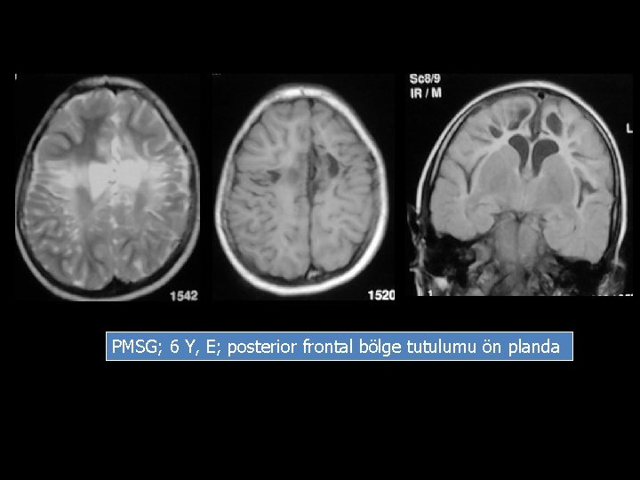 PMSG; 6 Y, E; posterior frontal bölge tutulumu ön planda 
