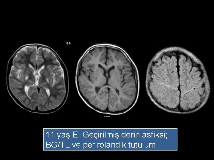 11 yaş E; Geçirilmiş derin asfiksi; BG/TL ve perirolandik tutulum 
