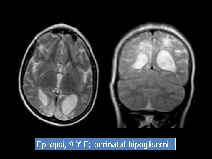 Epilepsi, 9 Y E; perinatal hipoglisemi 