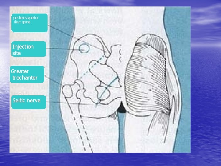 posterosuperior iliac spine Injection site Greater trochanter Seitic nerve 
