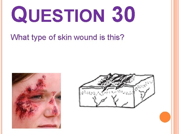 QUESTION 30 What type of skin wound is this? 