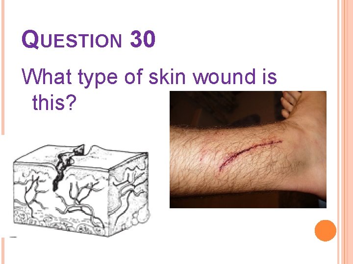 QUESTION 30 What type of skin wound is this? 