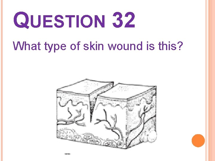 QUESTION 32 What type of skin wound is this? 