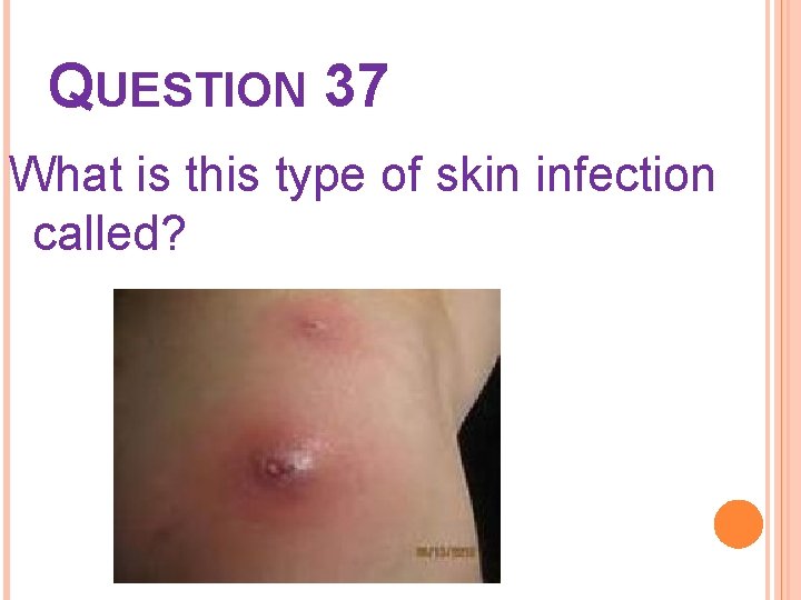 QUESTION 37 What is this type of skin infection called? 