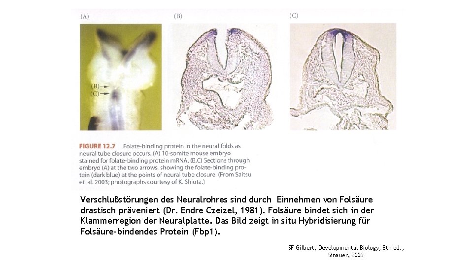 Verschlußstörungen des Neuralrohres sind durch Einnehmen von Folsäure drastisch präveniert (Dr. Endre Czeizel, 1981).