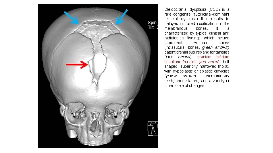 Cleidocranial dysplasia (CCD) is a rare congenital autosomal-dominant skeletal dysplasia that results in delayed