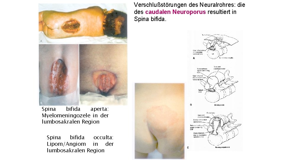 Verschlußstörungen des Neuralrohres: die des caudalen Neuroporus resultiert in Spina bifida aperta: Myelomeningozele in