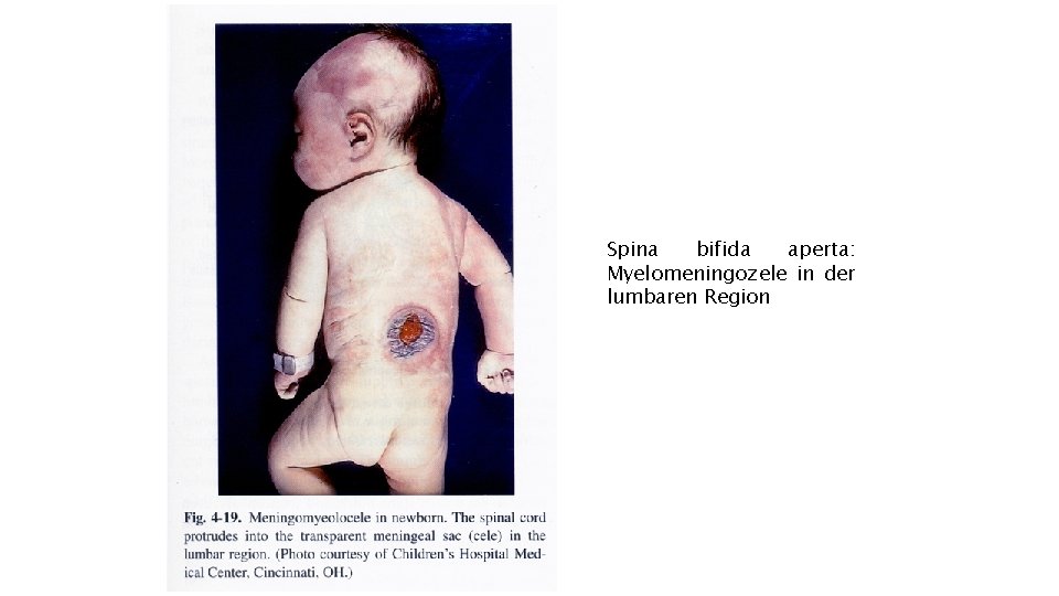 Spina bifida aperta: Myelomeningozele in der lumbaren Region 