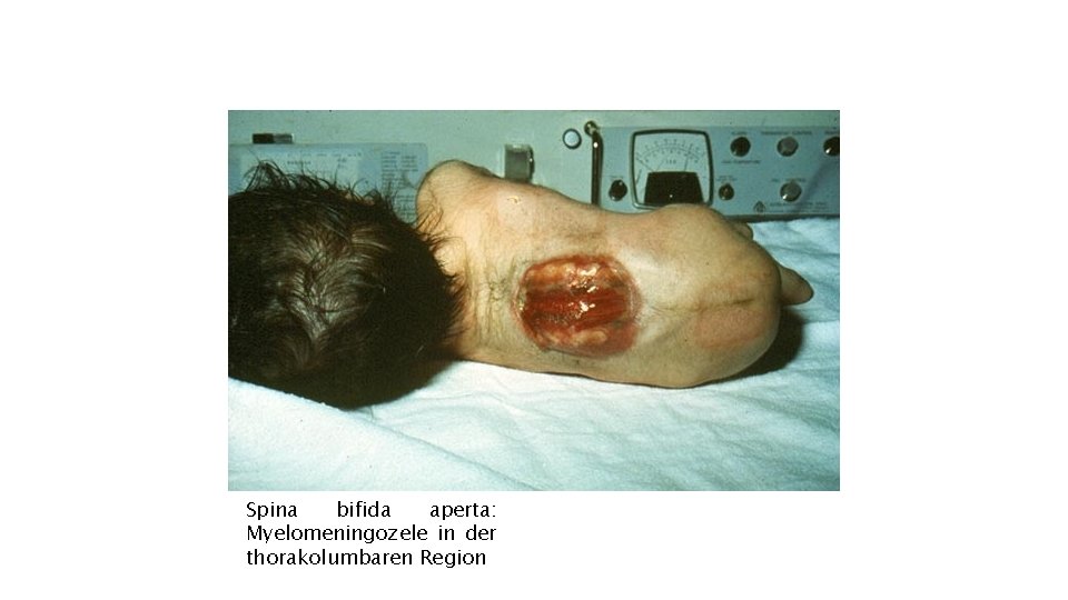 Spina bifida aperta: Myelomeningozele in der thorakolumbaren Region 