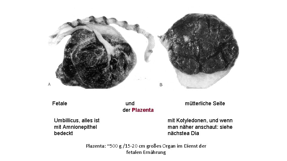 Fetale und der Plazenta Umbillicus, alles ist mit Amnionepithel bedeckt mütterliche Seite mit Kotyledonen,