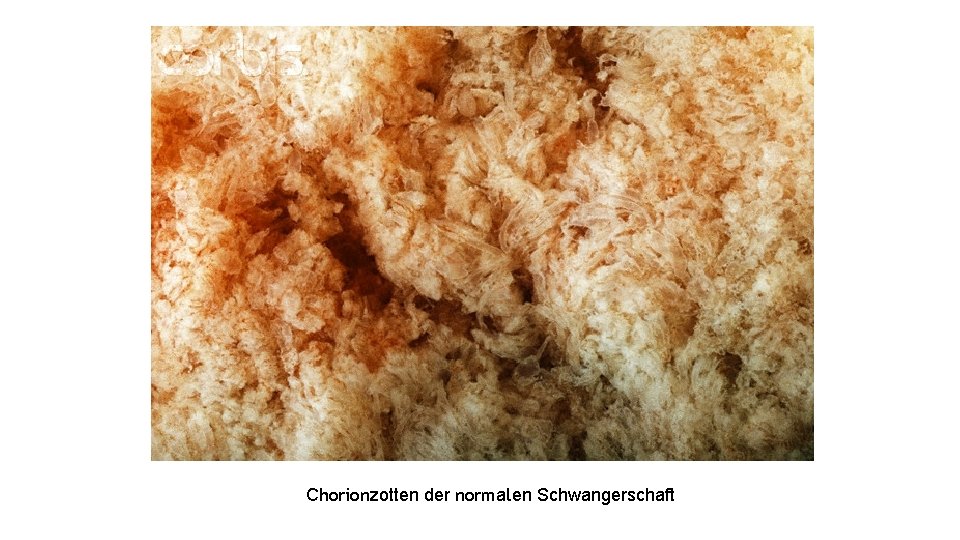 Chorionzotten der normalen Schwangerschaft 