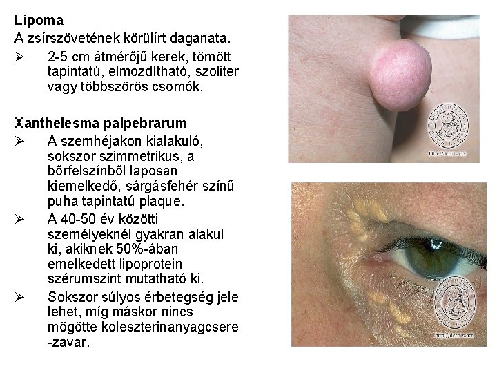 Lipoma A zsírszövetének körülírt daganata. Ø 2 -5 cm átmérőjű kerek, tömött tapintatú, elmozdítható,