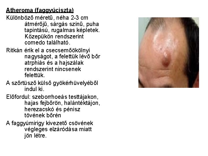 Atheroma (faggyúciszta) Különböző méretű, néha 2 -3 cm átmérőjű, sárgás színű, puha tapintású, rugalmas