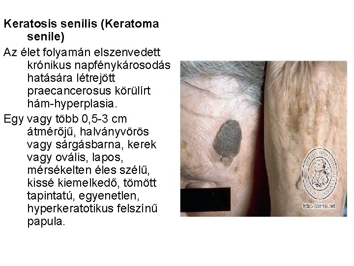 Keratosis senilis (Keratoma senile) Az élet folyamán elszenvedett krónikus napfénykárosodás hatására létrejött praecancerosus körülírt
