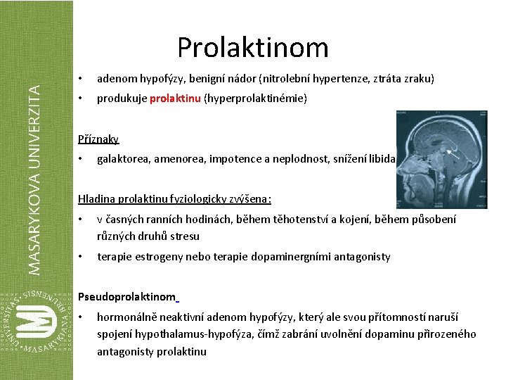 Prolaktinom • adenom hypofýzy, benigní nádor (nitrolební hypertenze, ztráta zraku) • produkuje prolaktinu (hyperprolaktinémie)