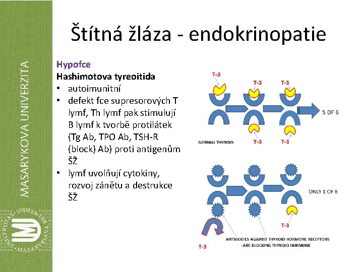 Štítná žláza - endokrinopatie Hypofce Hashimotova tyreoitida • autoimunitní • defekt fce supresorových T