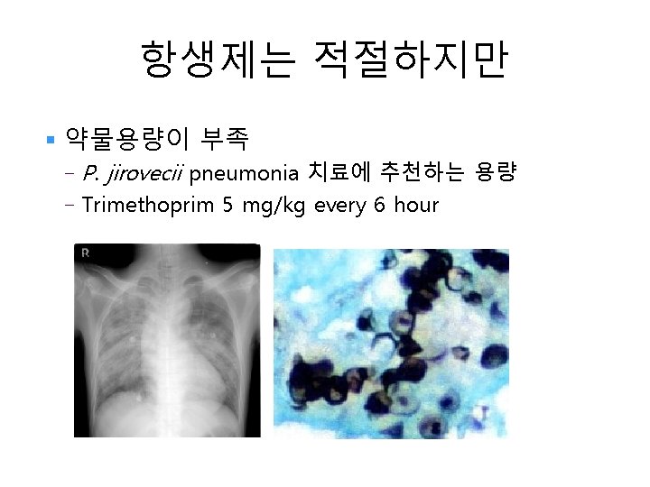 항생제는 적절하지만 § 약물용량이 부족 - P. jirovecii pneumonia 치료에 추천하는 용량 - Trimethoprim