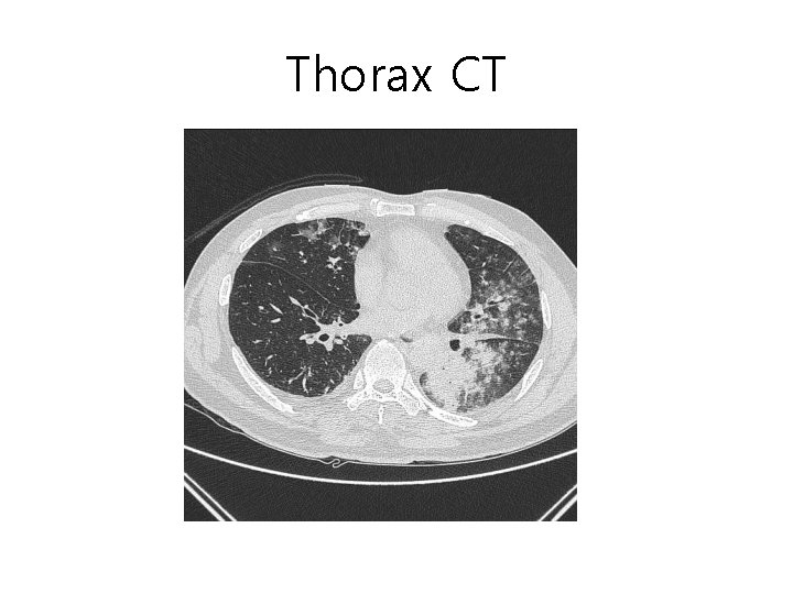 Thorax CT 