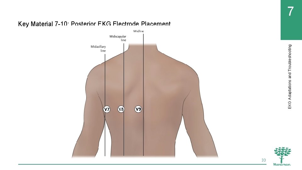7 EKG Adaptations and Troubleshooting Key Material 7 -10: Posterior EKG Electrode Placement 33