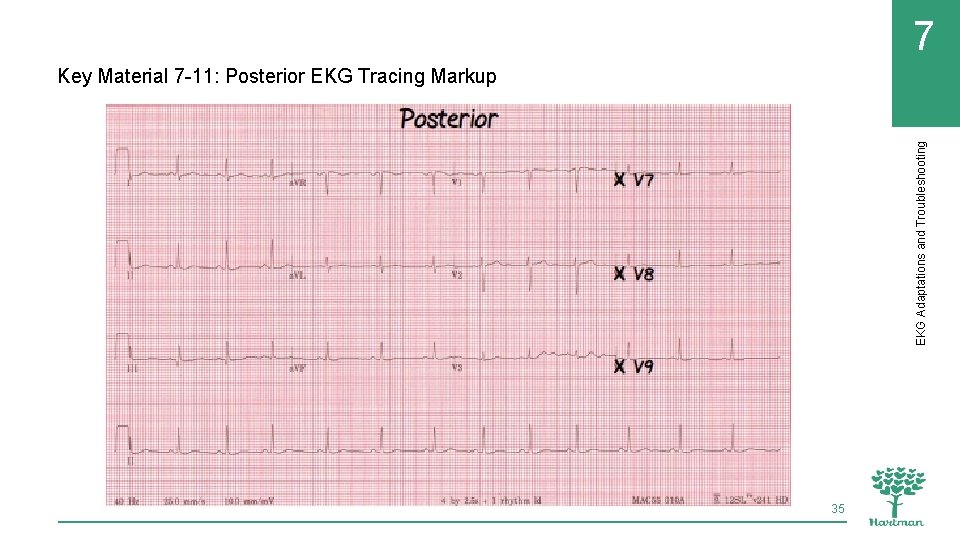 7 EKG Adaptations and Troubleshooting Key Material 7 -11: Posterior EKG Tracing Markup 35