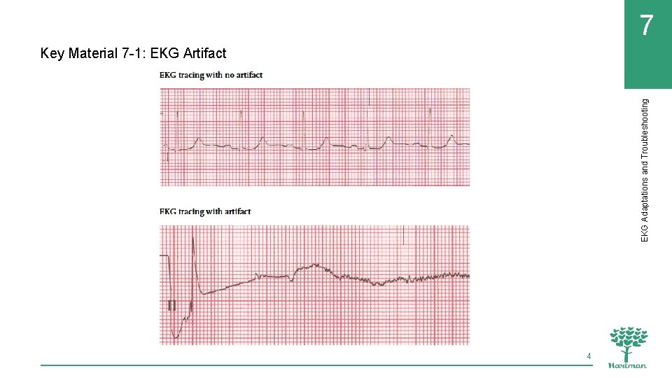 EKG Adaptations and Troubleshooting 7 Key Material 7 -1: EKG Artifact 4 
