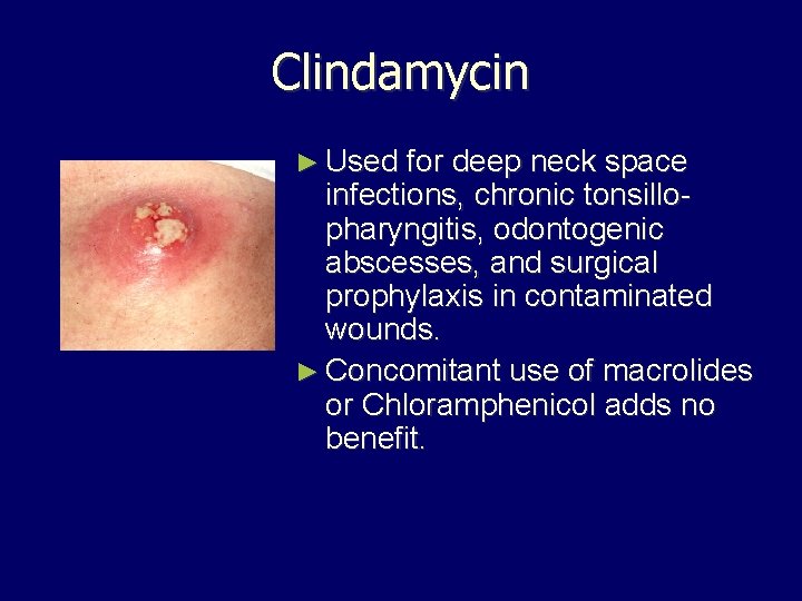 Clindamycin ► Used for deep neck space infections, chronic tonsillopharyngitis, odontogenic abscesses, and surgical