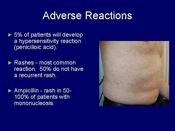 Adverse Reactions ► 5% of patients will develop a hypersensitivity reaction (penicilloic acid). ►