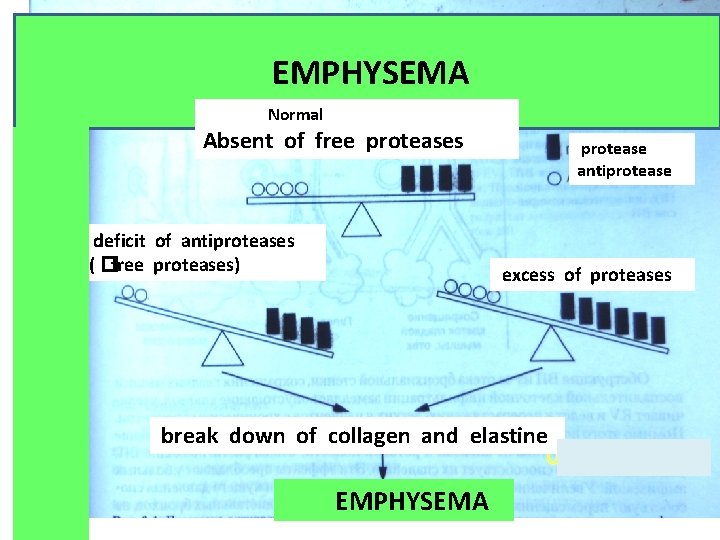 EMPHYSEMA Normal Absent of free proteases deficit of antiproteases ( �free proteases) protease antiprotease
