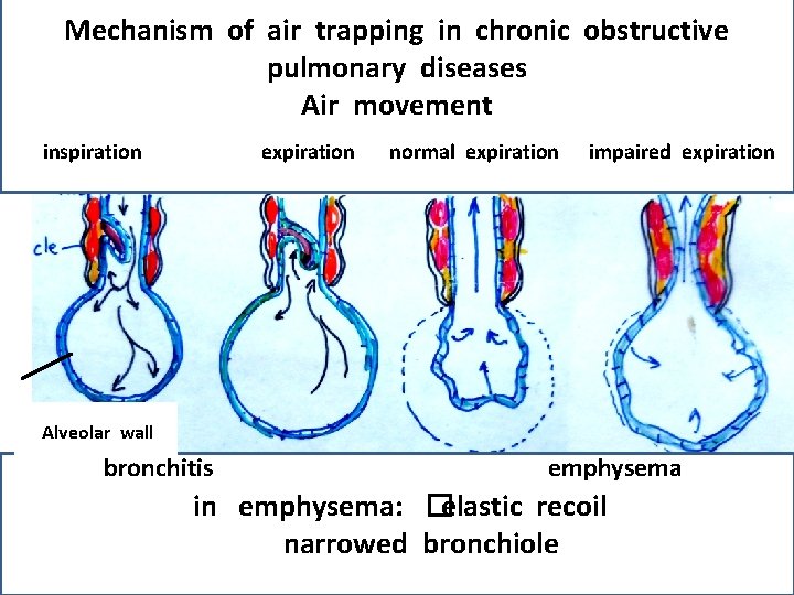 Mechanism of air trapping in chronic obstructive pulmonary diseases Air movement inspiration expiration normal