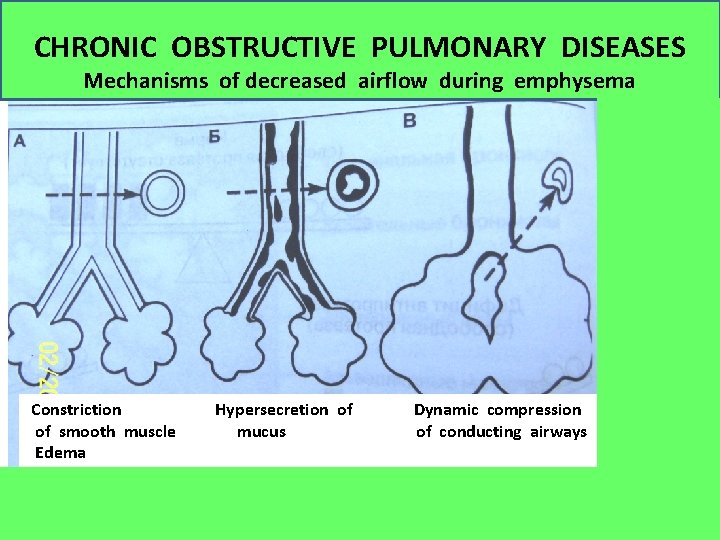 CHRONIC OBSTRUCTIVE PULMONARY DISEASES Mechanisms of decreased airflow during emphysema Constriction of smooth muscle