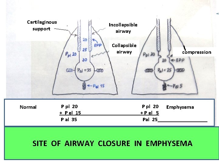 Cartilaginous support Incollapsible airway Collapsible airway Normal P pl 20 + P el 15