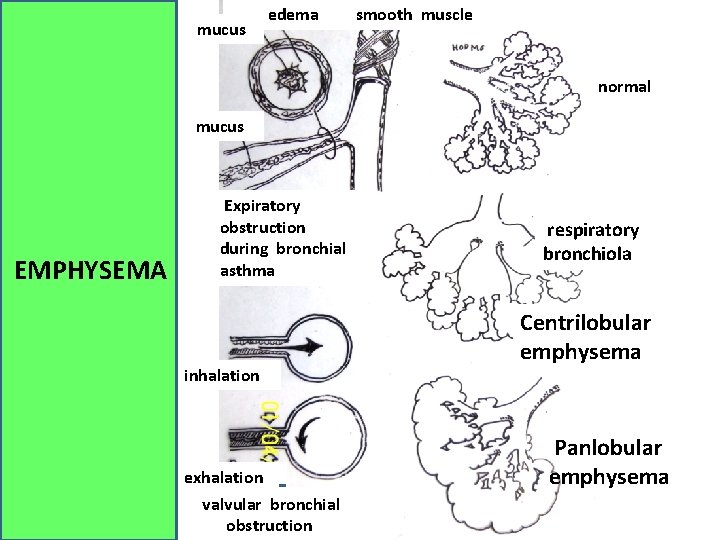 mucus edema smooth muscle normal mucus EMPHYSEMA Expiratory obstruction during bronchial asthma inhalation exhalation