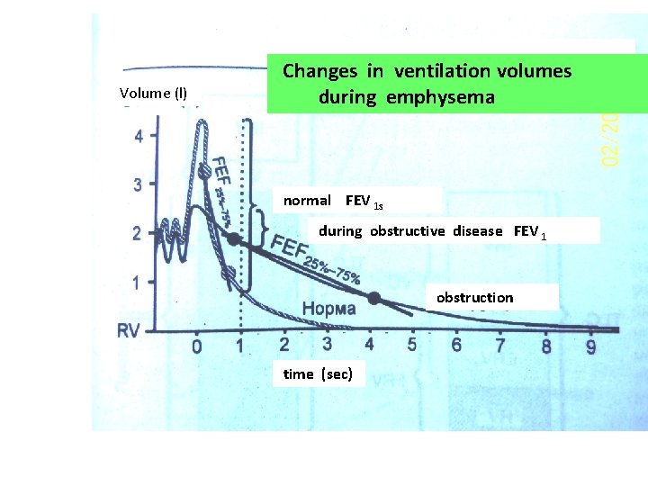 Volume (l) Changes in ventilation volumes during emphysema normal FEV 1 s during obstructive