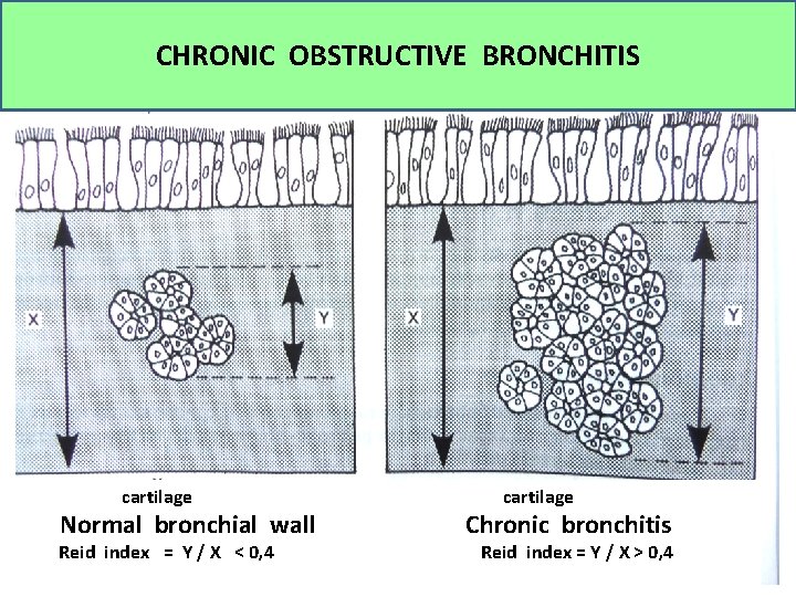 CHRONIC OBSTRUCTIVE BRONCHITIS cartilage Normal bronchial wall Reid index = Y / X <