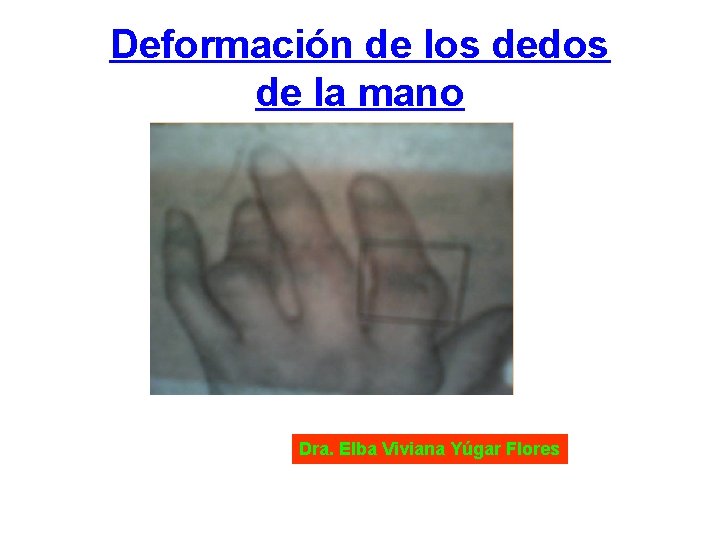 Deformación de los dedos de la mano Dra. Elba Viviana Yúgar Flores 