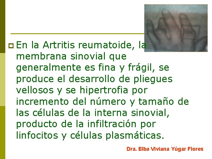 p En la Artritis reumatoide, la membrana sinovial que generalmente es fina y frágil,