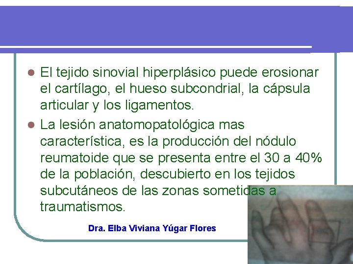 El tejido sinovial hiperplásico puede erosionar el cartílago, el hueso subcondrial, la cápsula articular
