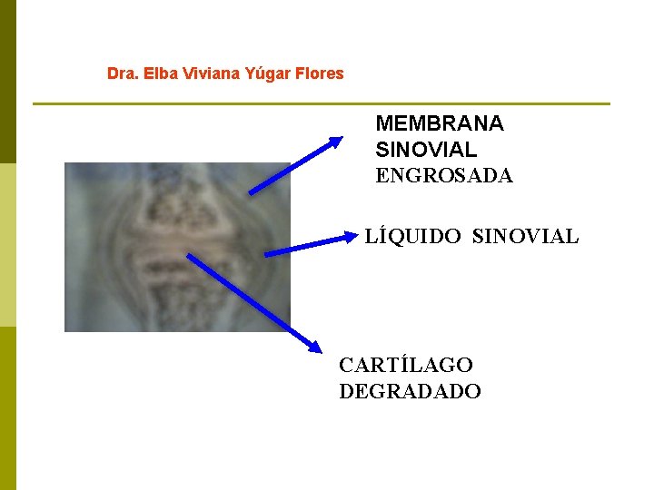 Dra. Elba Viviana Yúgar Flores MEMBRANA SINOVIAL ENGROSADA LÍQUIDO SINOVIAL CARTÍLAGO DEGRADADO 