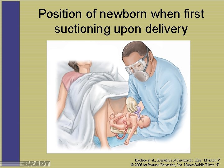 Position of newborn when first suctioning upon delivery Bledsoe et al. , Essentials of