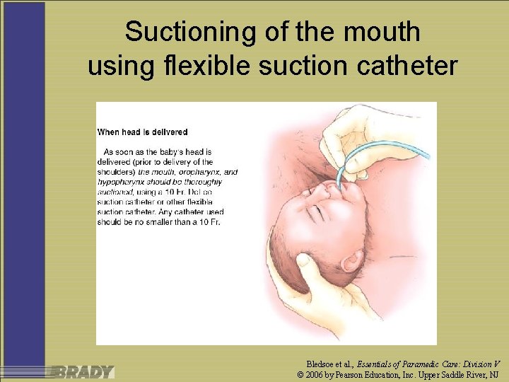Suctioning of the mouth using flexible suction catheter Bledsoe et al. , Essentials of