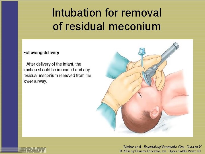 Intubation for removal of residual meconium Bledsoe et al. , Essentials of Paramedic Care: