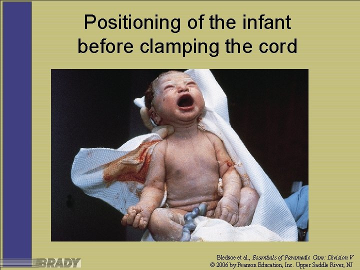 Positioning of the infant before clamping the cord Bledsoe et al. , Essentials of