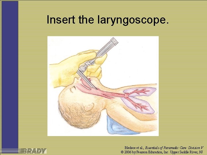 Insert the laryngoscope. Bledsoe et al. , Essentials of Paramedic Care: Division V ©