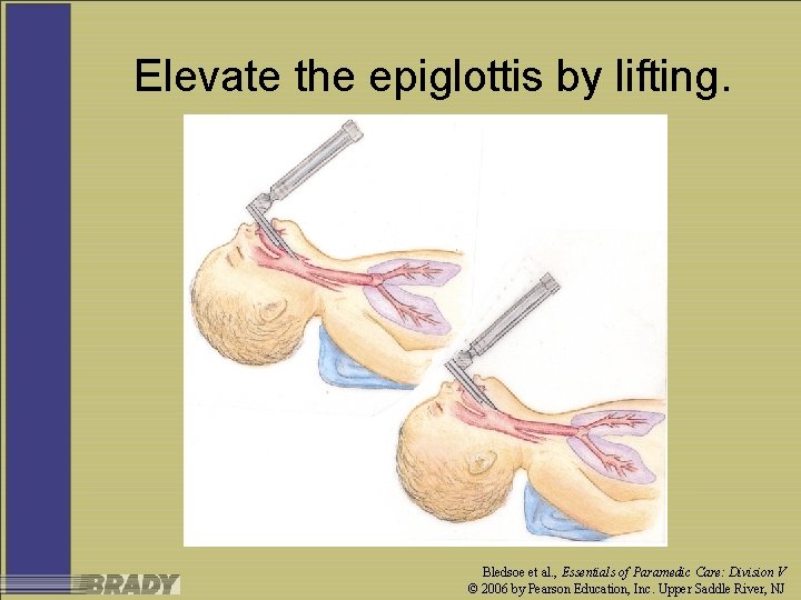 Elevate the epiglottis by lifting. Bledsoe et al. , Essentials of Paramedic Care: Division