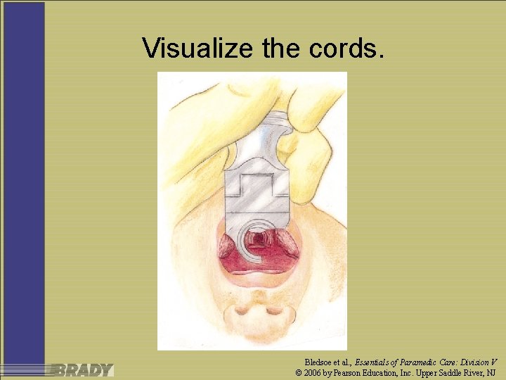 Visualize the cords. Bledsoe et al. , Essentials of Paramedic Care: Division V ©