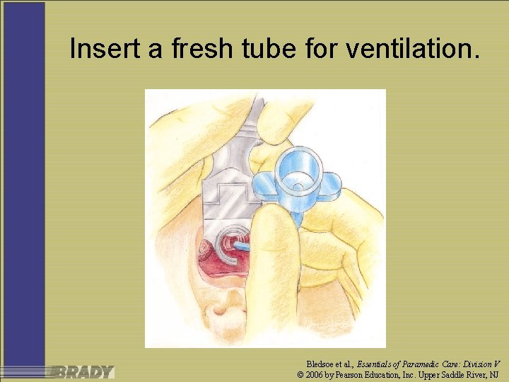Insert a fresh tube for ventilation. Bledsoe et al. , Essentials of Paramedic Care: