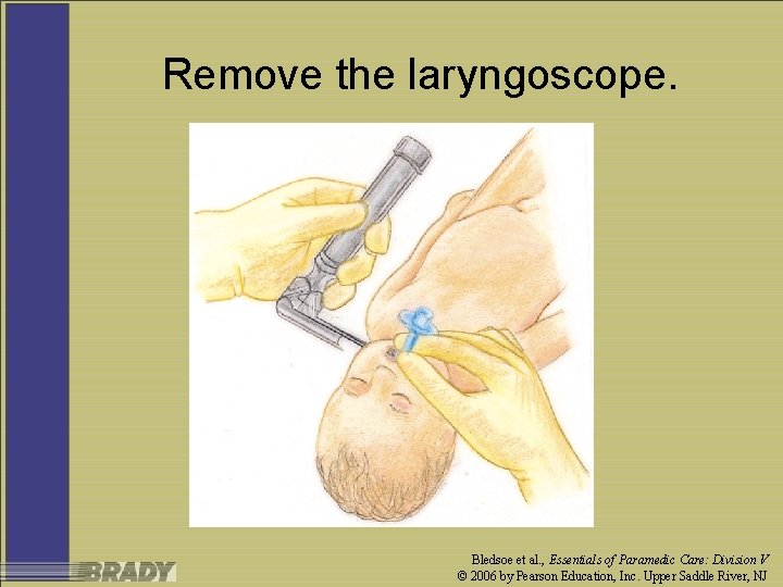 Remove the laryngoscope. Bledsoe et al. , Essentials of Paramedic Care: Division V ©